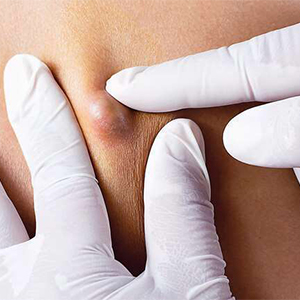 کیست یا توده چیست؟